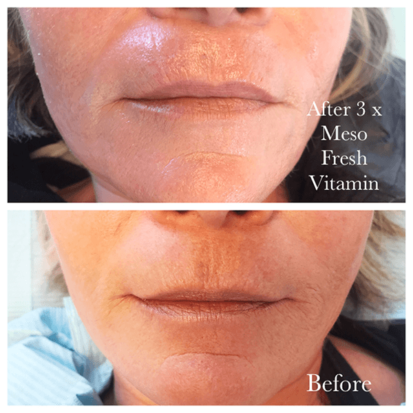 Buy Meso Fresh Vitamin – Vitamin Mesotherapy | Mesoskinline